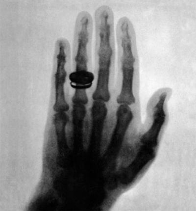 Перший рентгенівський знімок